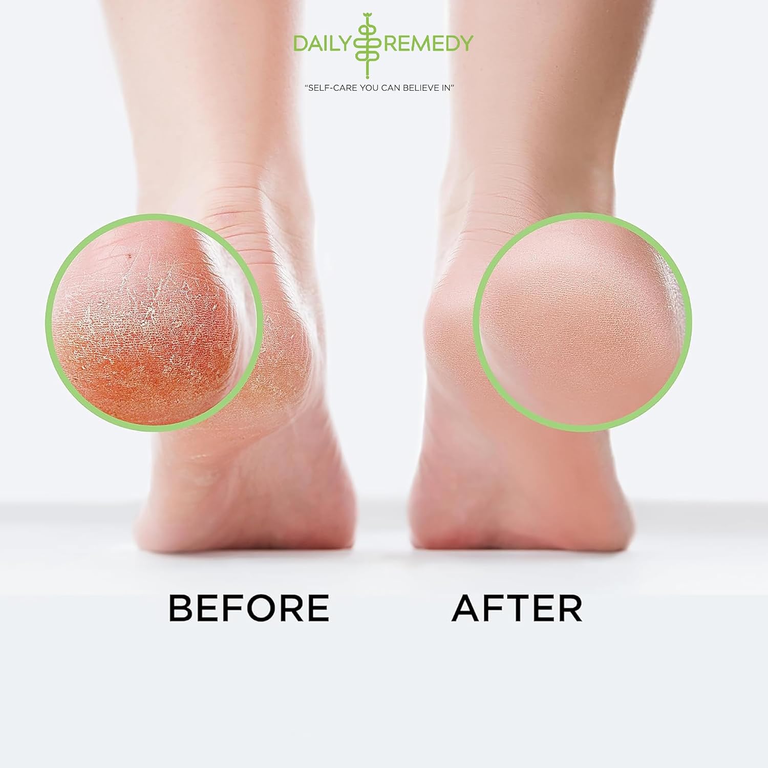 Tea Tree Oil Foot Soak with Epsom Salt - Made in USA - for Toenail Athletes Foot, Stubborn Foot Odor Scent, Softens Calluses & Soothes Sore Tired Feet - 16 Ounces - Image 6